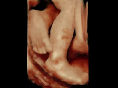 胎児超音波スクリーニング検査による胎児の様子３