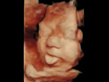 胎児超音波スクリーニング検査による胎児の様子４
